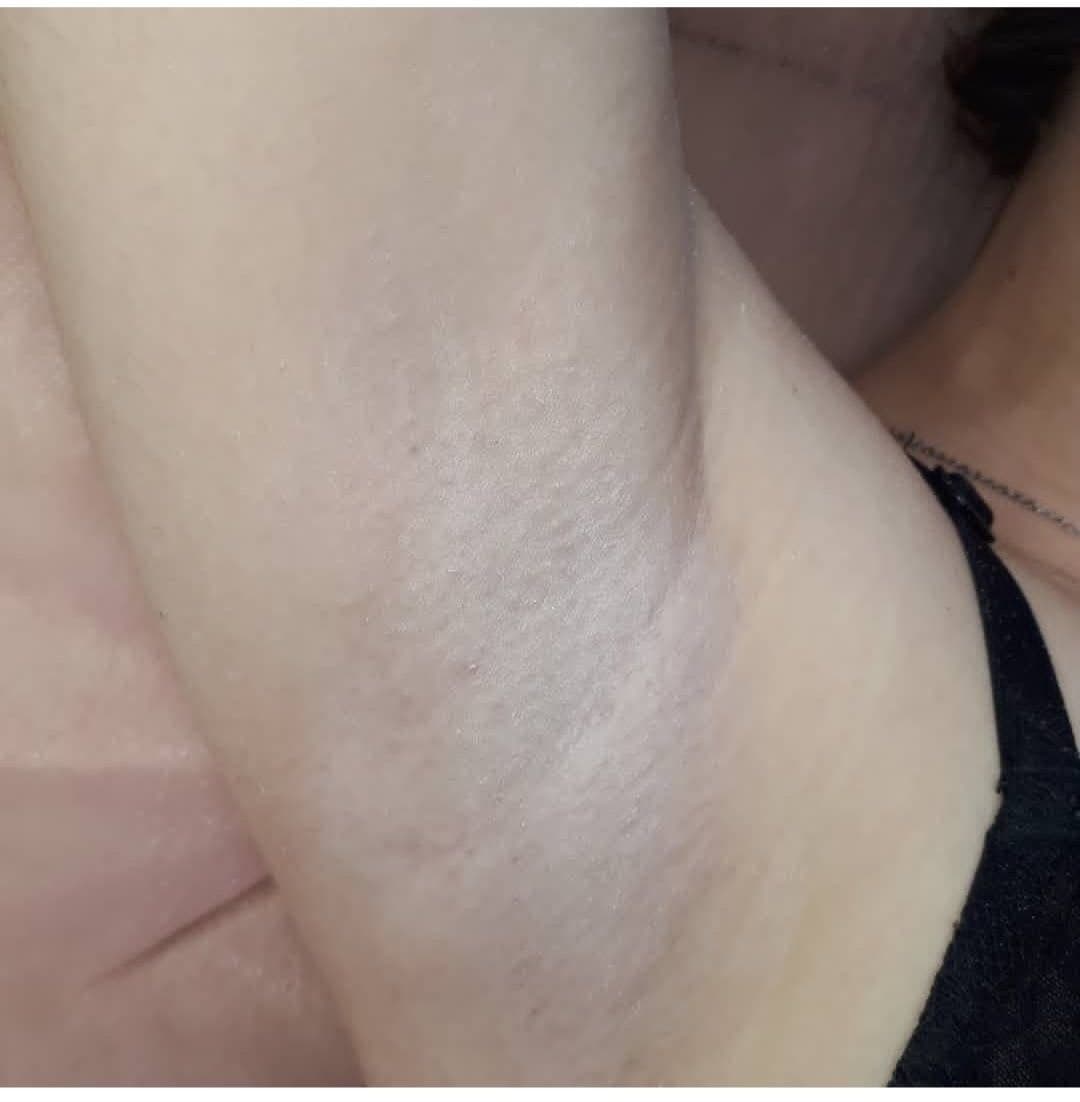 After treatment — smooth armpit