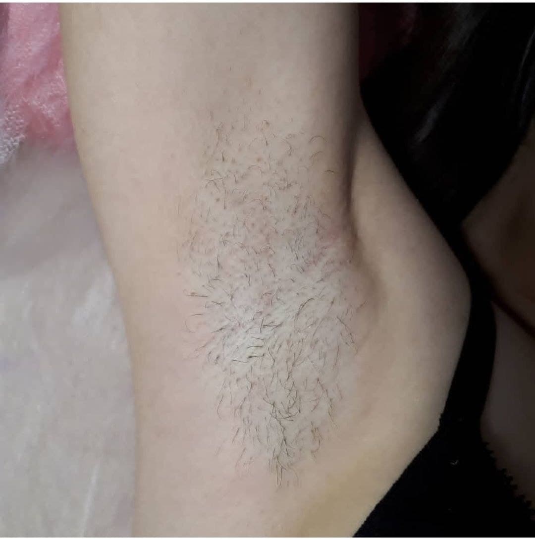 During treatment — partial hair removal in progress